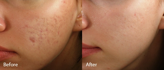 The after photo reflects progress after one month (three treatments).