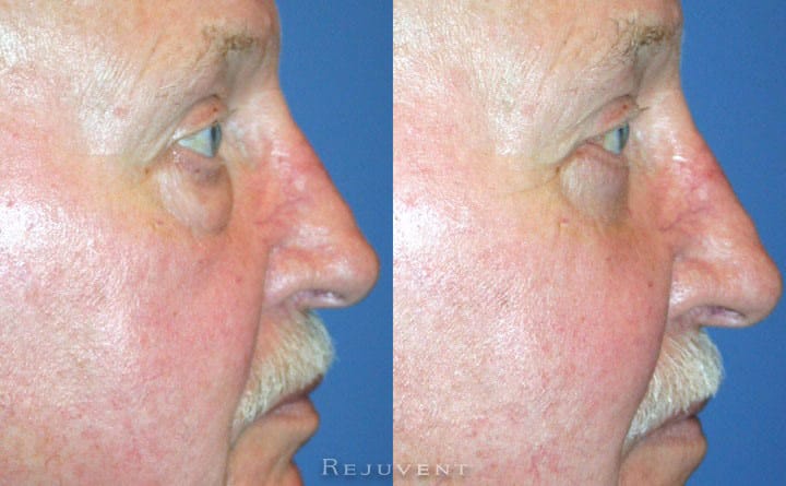 Lower Eyelid Blepharoplasty Photos • Rejuvent Medical Spa Scottsdale