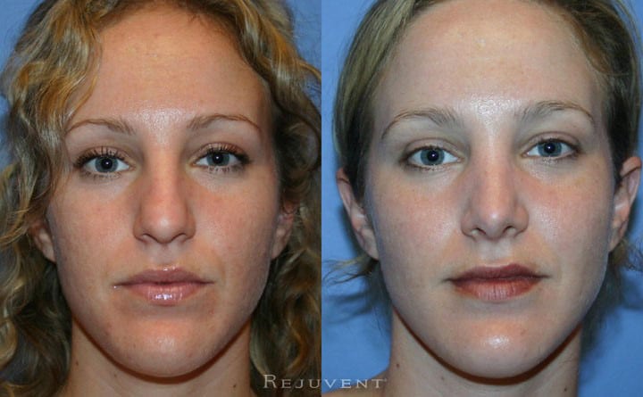 Rhinoplasty Photos at Rejuvent Scottsdale • Rejuvent Medical Spa Scottsdale