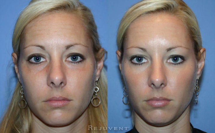 The Best Botox in Scottsdale is here! • Rejuvent Medical Spa and Surgery