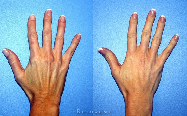 Before & After Photo Galleries • Rejuvent Medical Spa Scottsdale