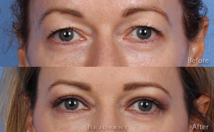 surgical reduction of the eyelids