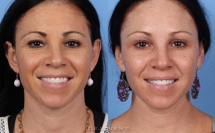 Botox Injections Scottsdale Beautiful Natural Results At Rejuvent 4302