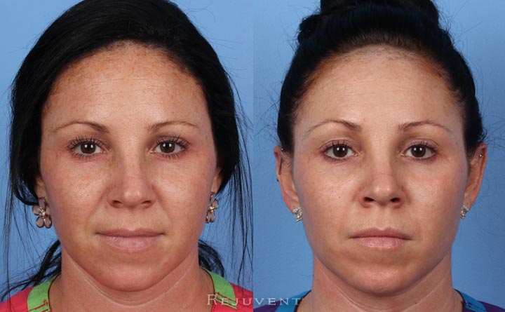 Fotofacial Ipl Photos • Rejuvent Medical Spa Scottsdale