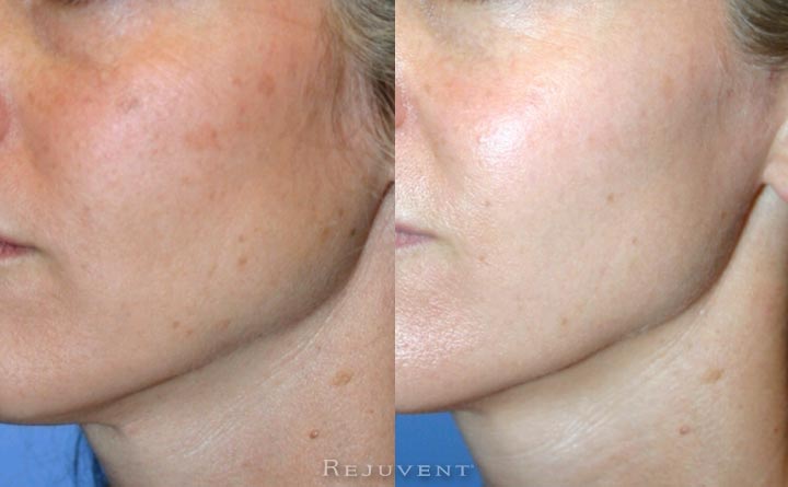 Aesthetic Skin Treatments • Rejuvent Medical Spa Scottsdale