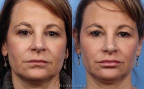 Cheek Fillers - Dermal Filler Cheek Injections - Rejuvent Scottsdale