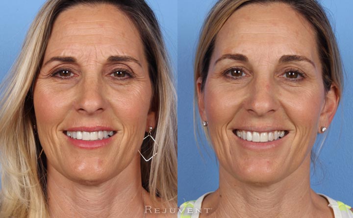 botox-and-wrinkle-relaxers-rejuvent-medical-spa-scottsdale