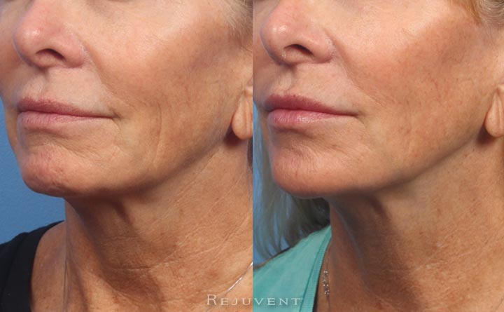 Lower Face Rejuvenation At Rejuvent 