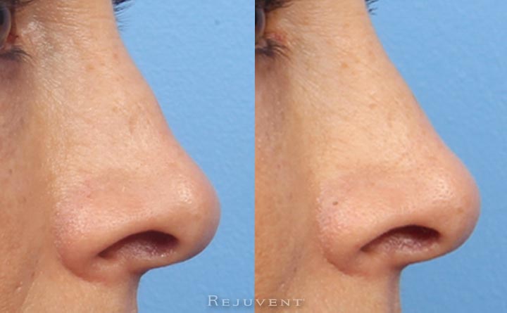 Non Surgical Nose enhancement with fillers