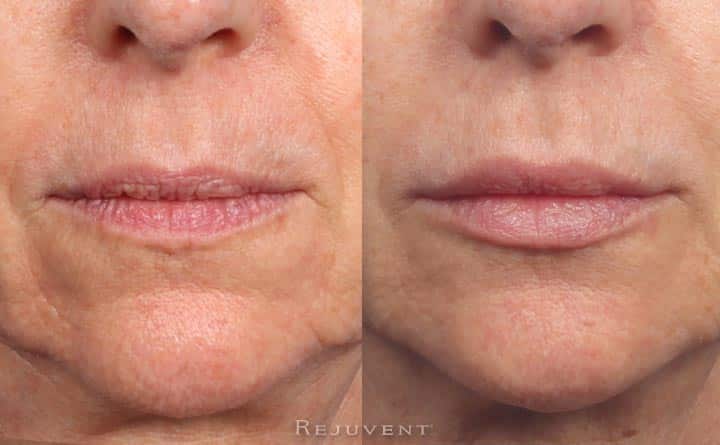 Lip Enhancement With Injectable Fillers • Rejuvent Scottsdale 