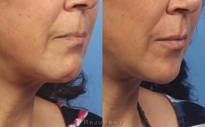 Lower Face Rejuvenation • Rejuvent Medical Spa Scottsdale