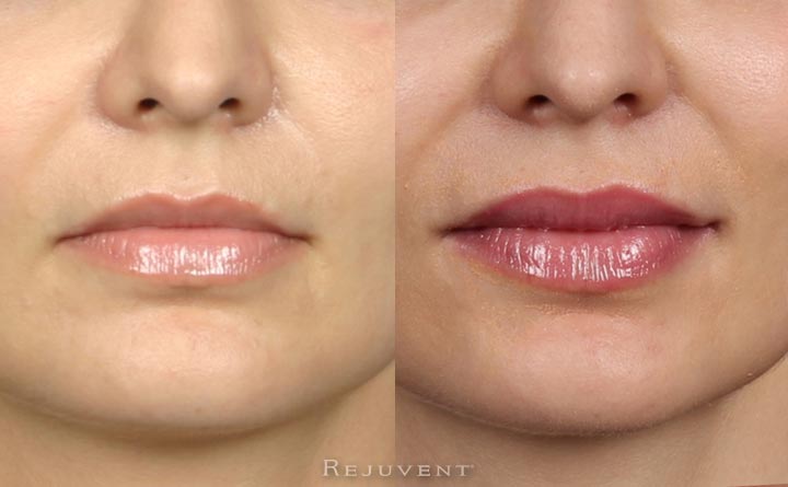 The Secret to Natural and Beautiful Lips Video • Rejuvent