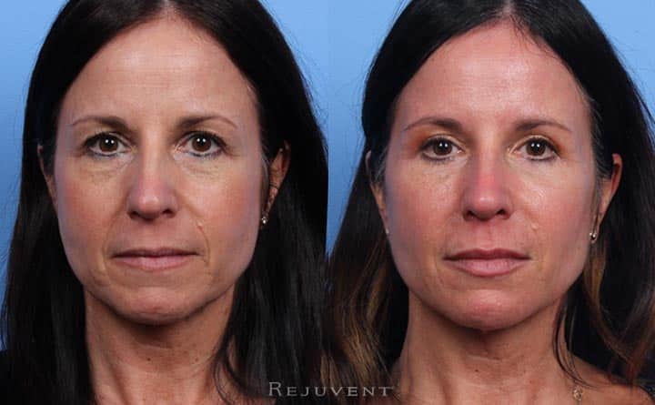 upper eyelid surgery before and after