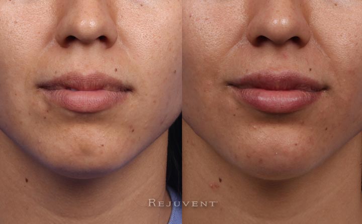 Non Surgical Chin Augmentation Photos • Rejuvent Medical Spa Scottsdale