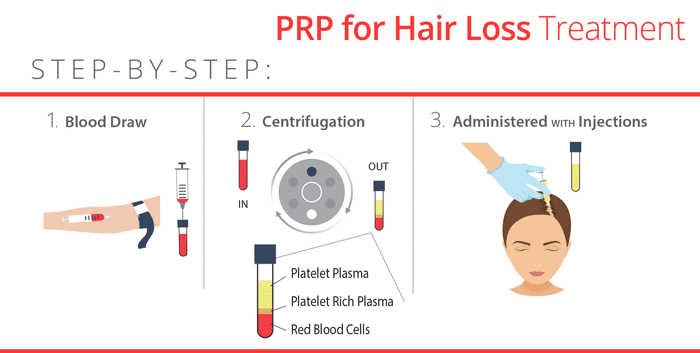 Prp For Hair Loss • Rejuvent Medical Spa Scottsdale