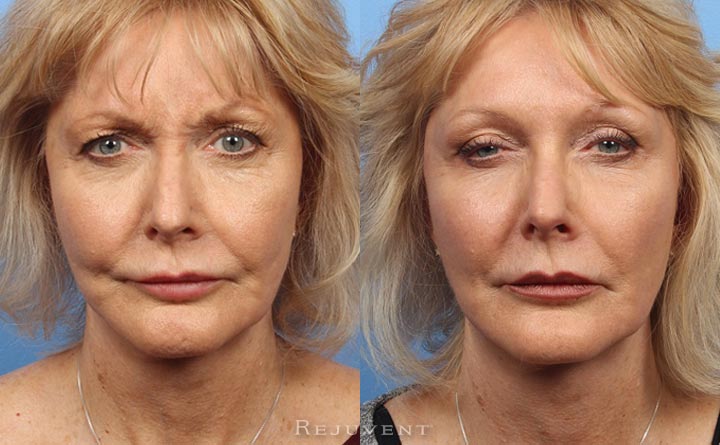 Botox Frown Lines Before After Results 