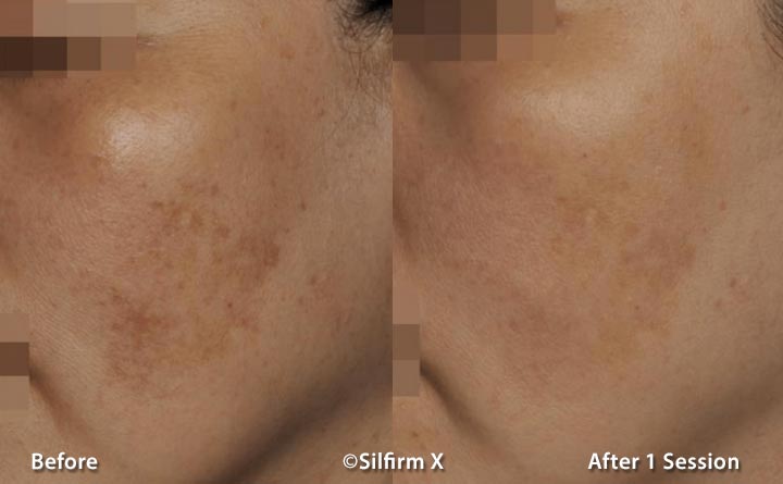 Silfirm X before and after pigmentation results