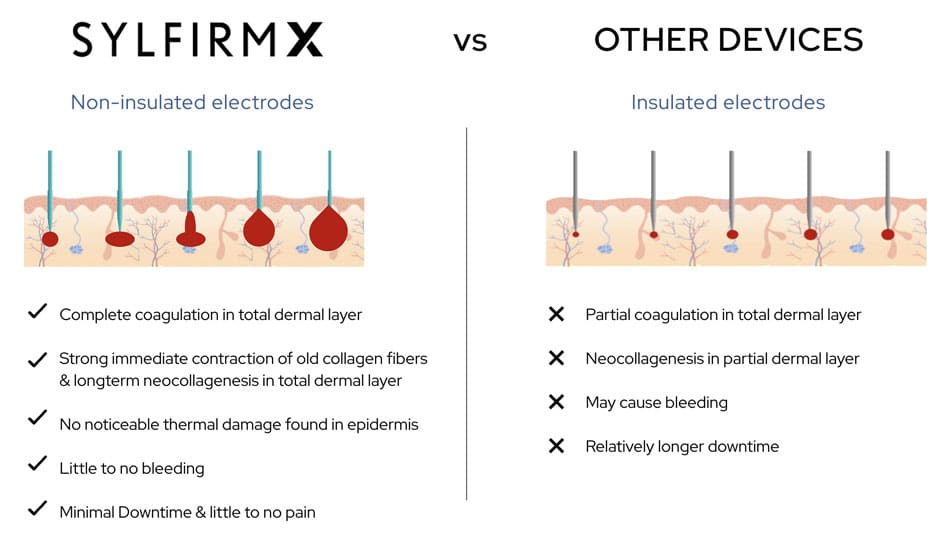 Silfirm X vs other RF microneedling devices