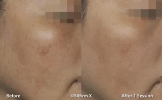 Sylfirm X before and after photo of skin pigmentation results
