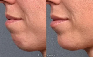 Side Chin view after Dysport and Filler