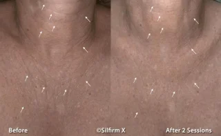 Sylfirm X neck before and after results