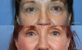 Undereye Rejuvenation with volumizing Fillers such as Perlane