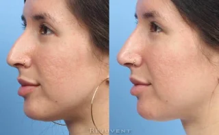 Amazing Non-Surgical Nose Results