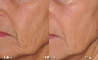 Sylfirm X before and after photo of neck and jawline results